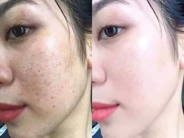 trước và sau khi điều trị