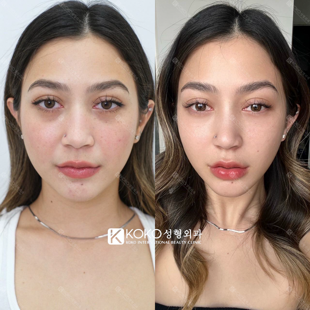 Những điều cần biết trước khi tiêm botox thon gọn hàm - Thẩm mỹ Quốc tế KOKO