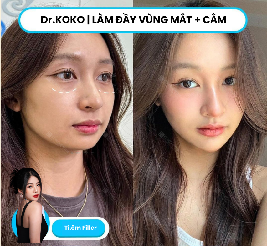 Hiệu quả của tiêm Filler làm đầy hốc mặt và cằm