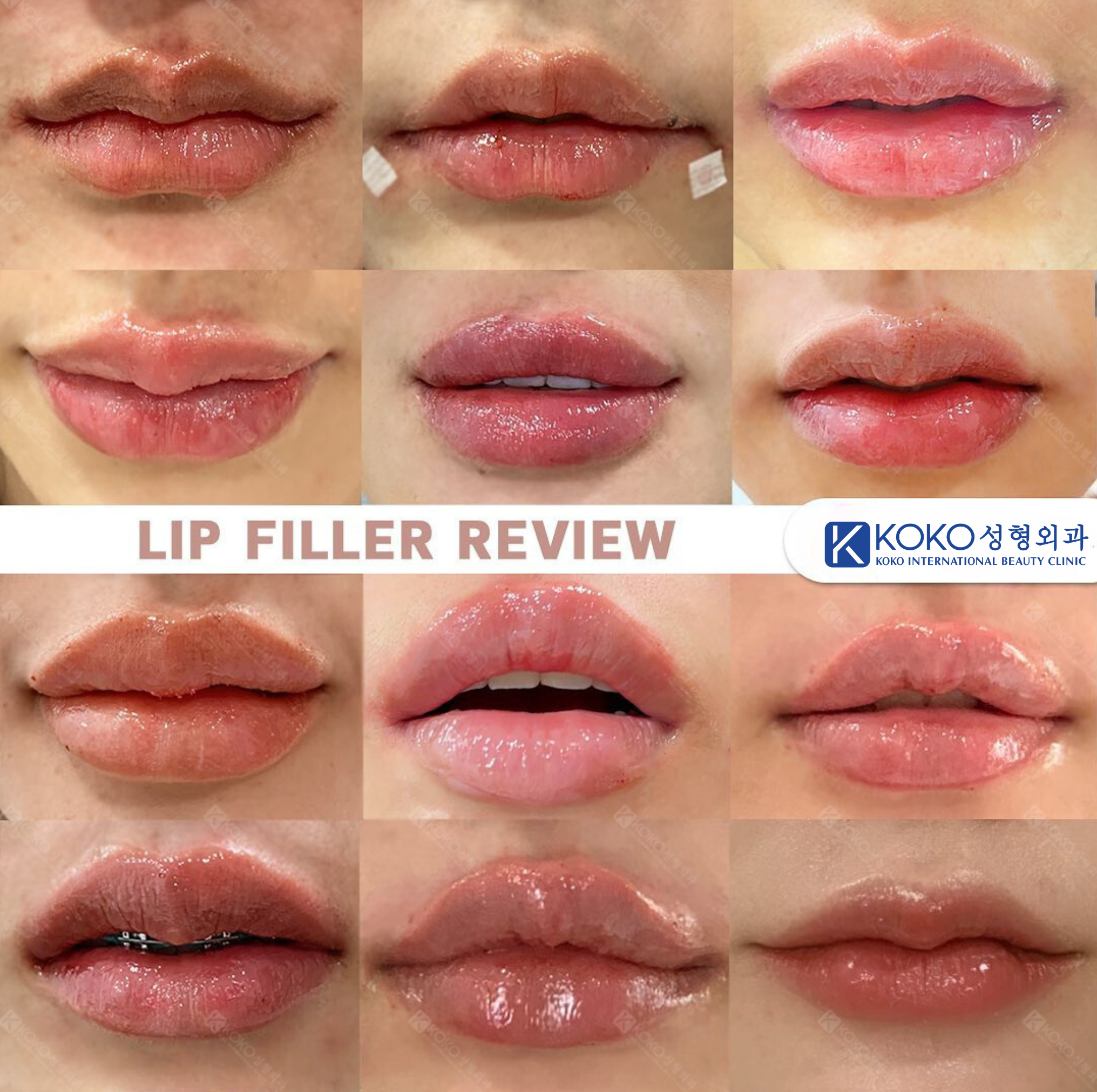 Tiêm filler tại Dr.KOKO