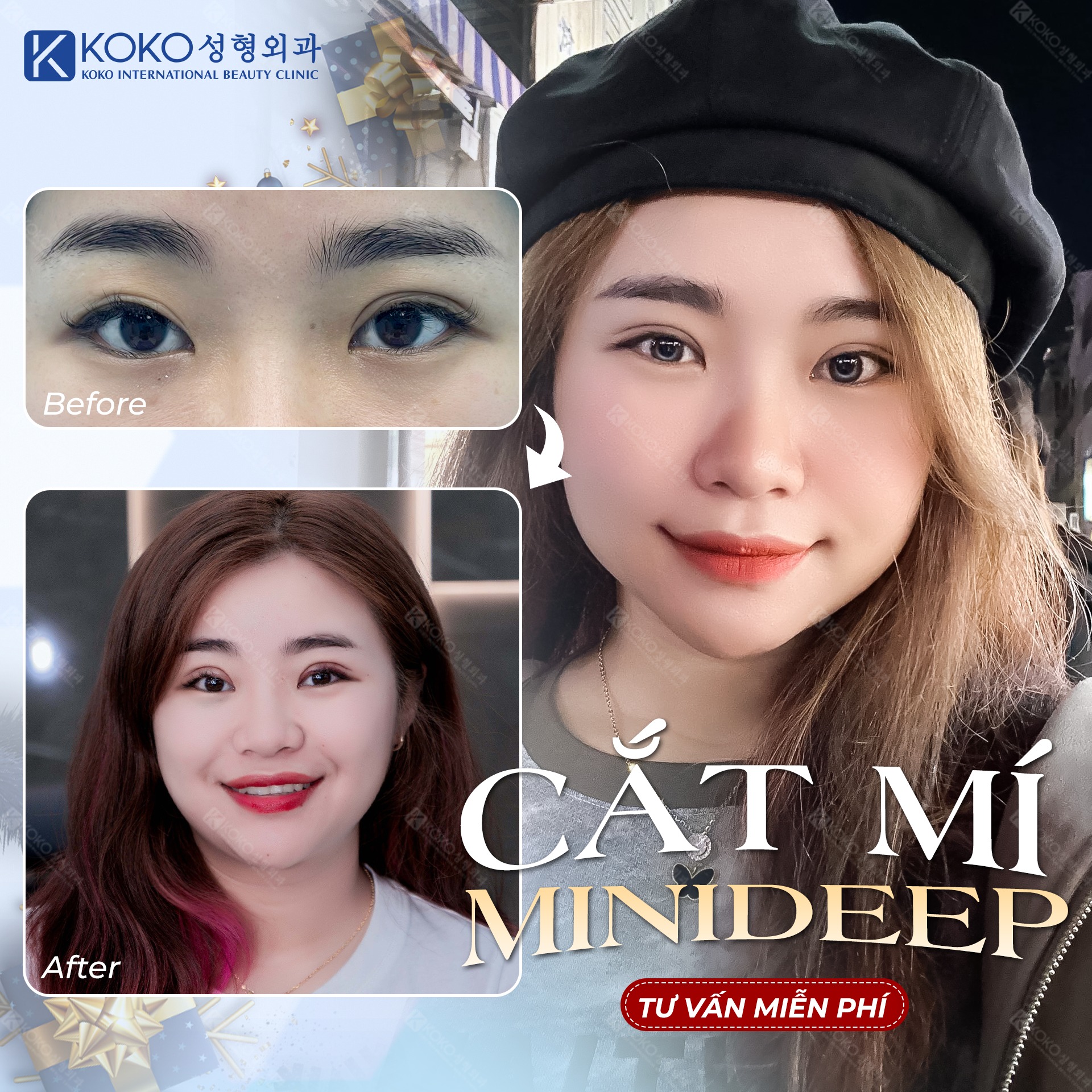 Công nghệ cắt mí Mini Deep nhà Dr.KOKO