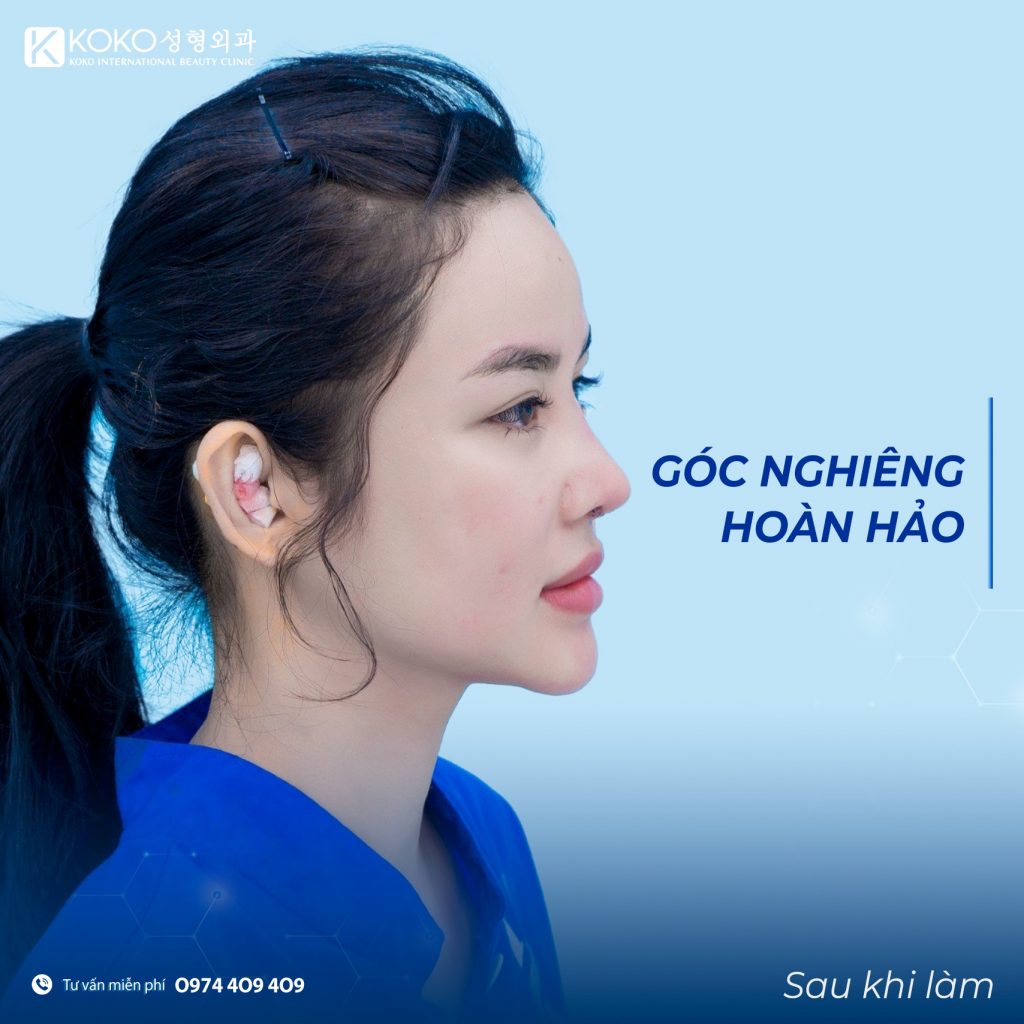 Nâng mũi bọc sụn tai có an toàn không?