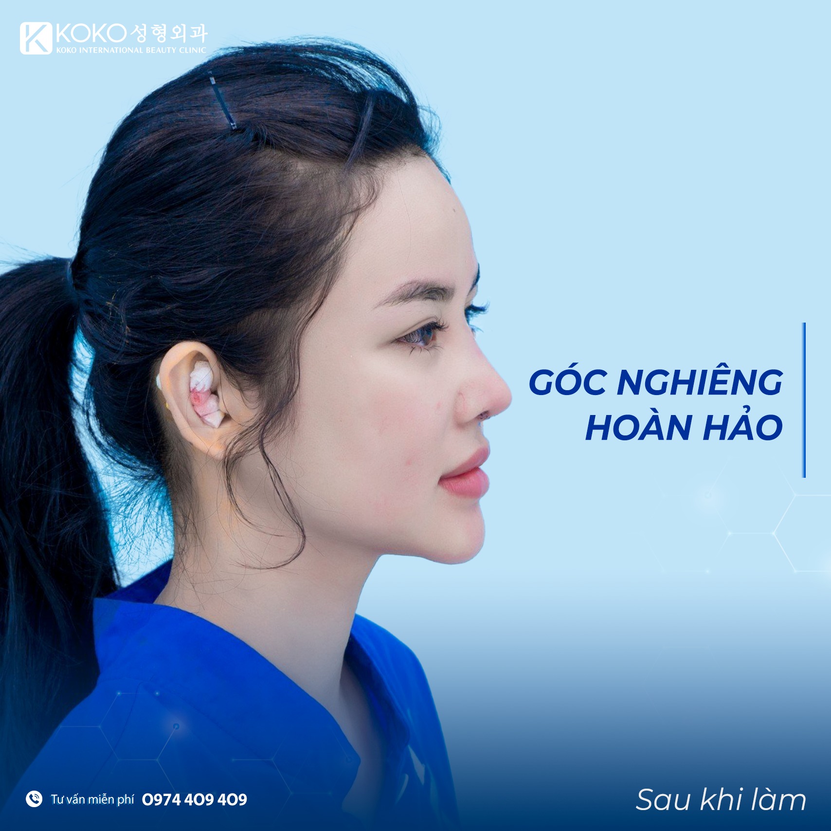 Nâng mũi phong thủy sở hữu góc nghiêng hoàn hảo