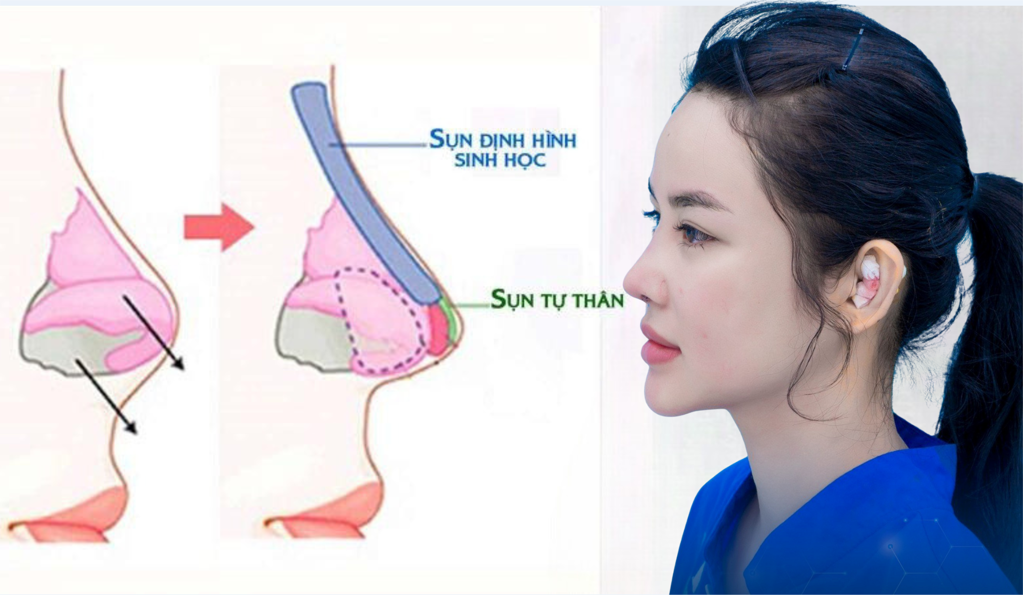 Các loại sụn nâng mũi tốt nhất hiện nay