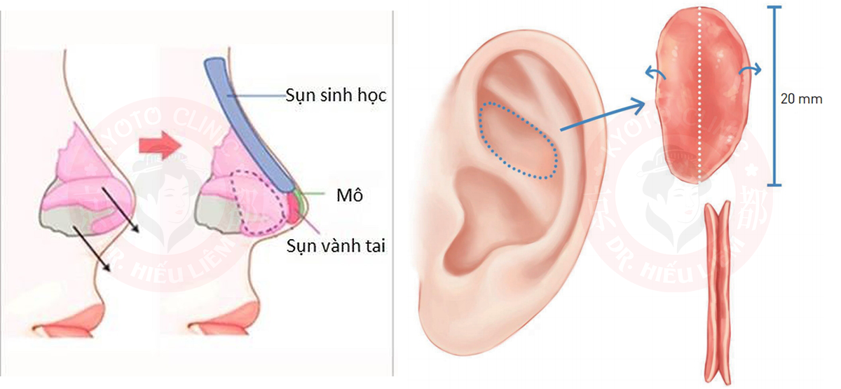 Sụn vành tai tạo hình đầu mũi