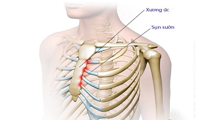 Nâng mũi bằng sụn sườn