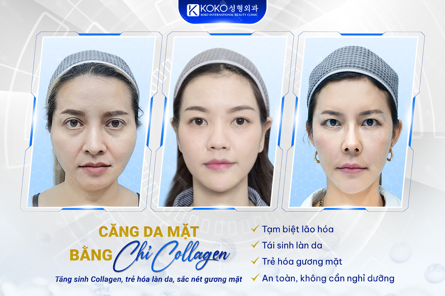 lợi ích tuyệt với khi căng da mặt bằng chỉ Collagen