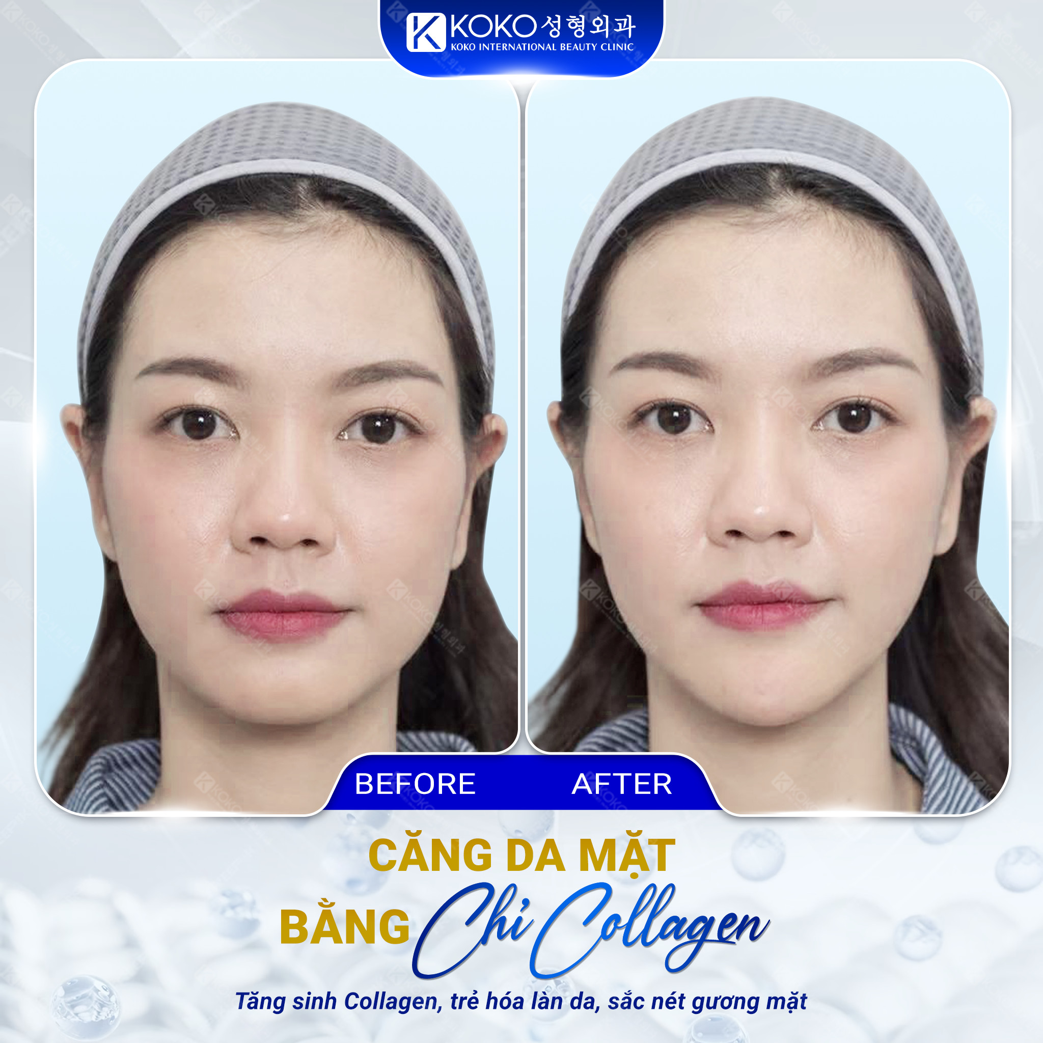 Lợi ích tuyệt với khi căng da mặt bằng chỉ Collagen