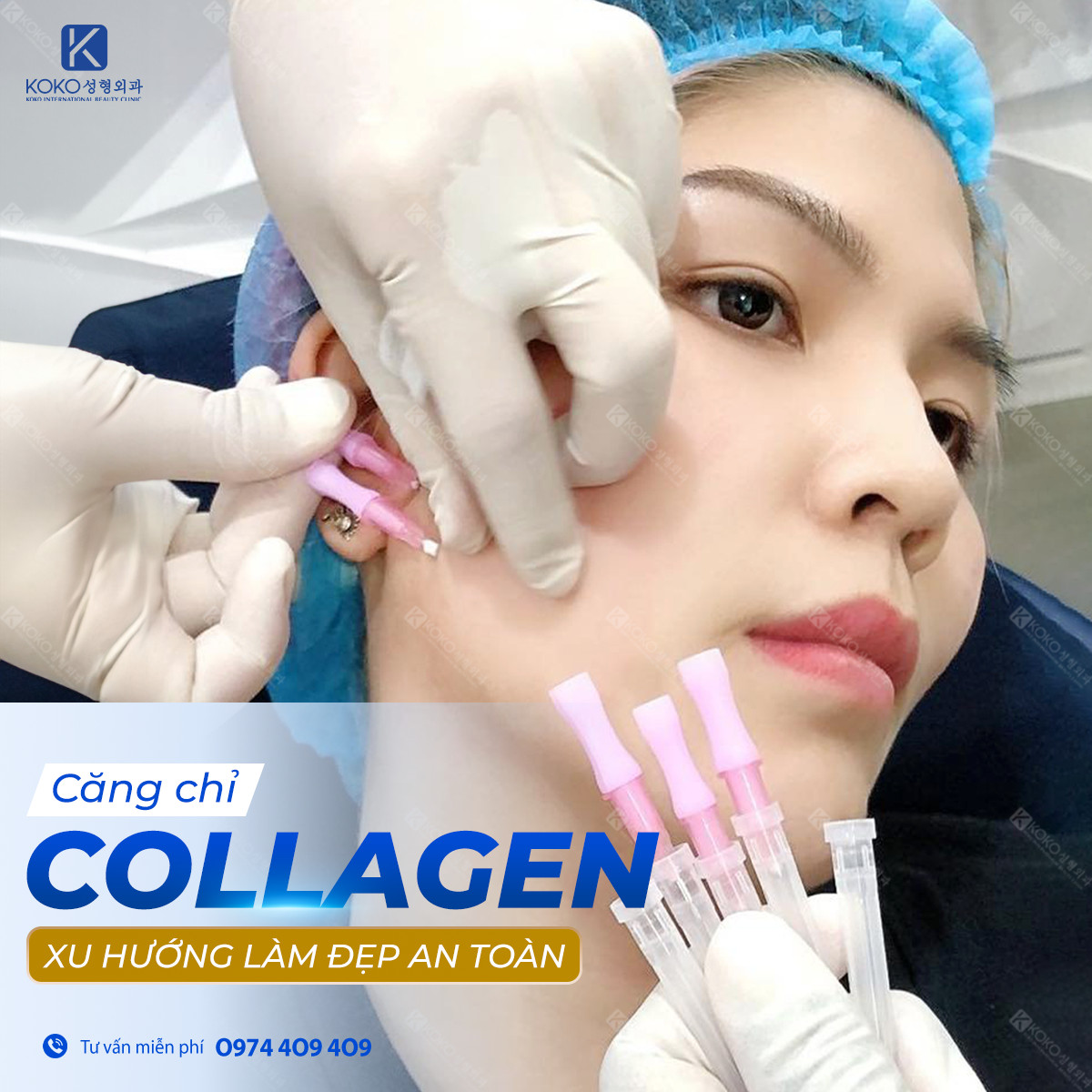 Căng da mặt bằng chỉ Collagen có tốt không?