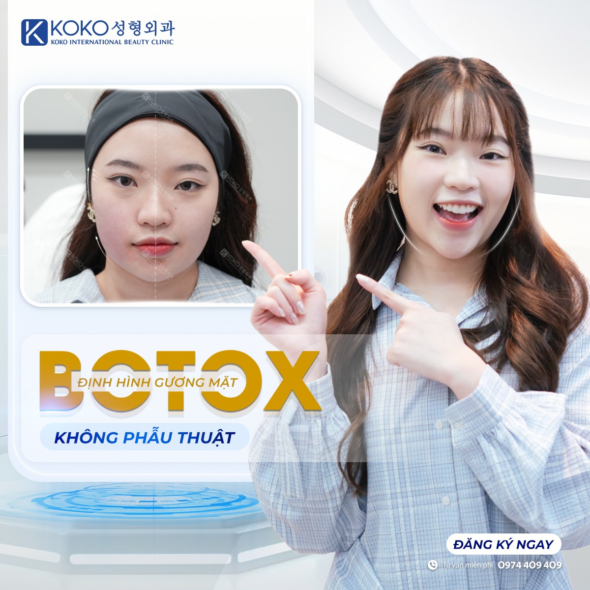 Tiêm botox làm thon gọn hàm