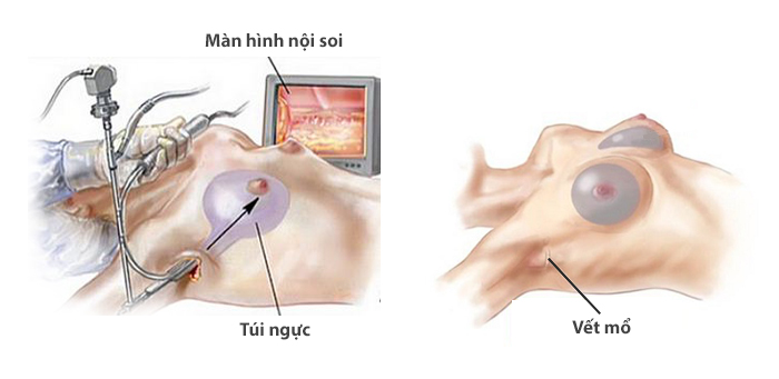 Nâng Ngực Qua Đường Nách