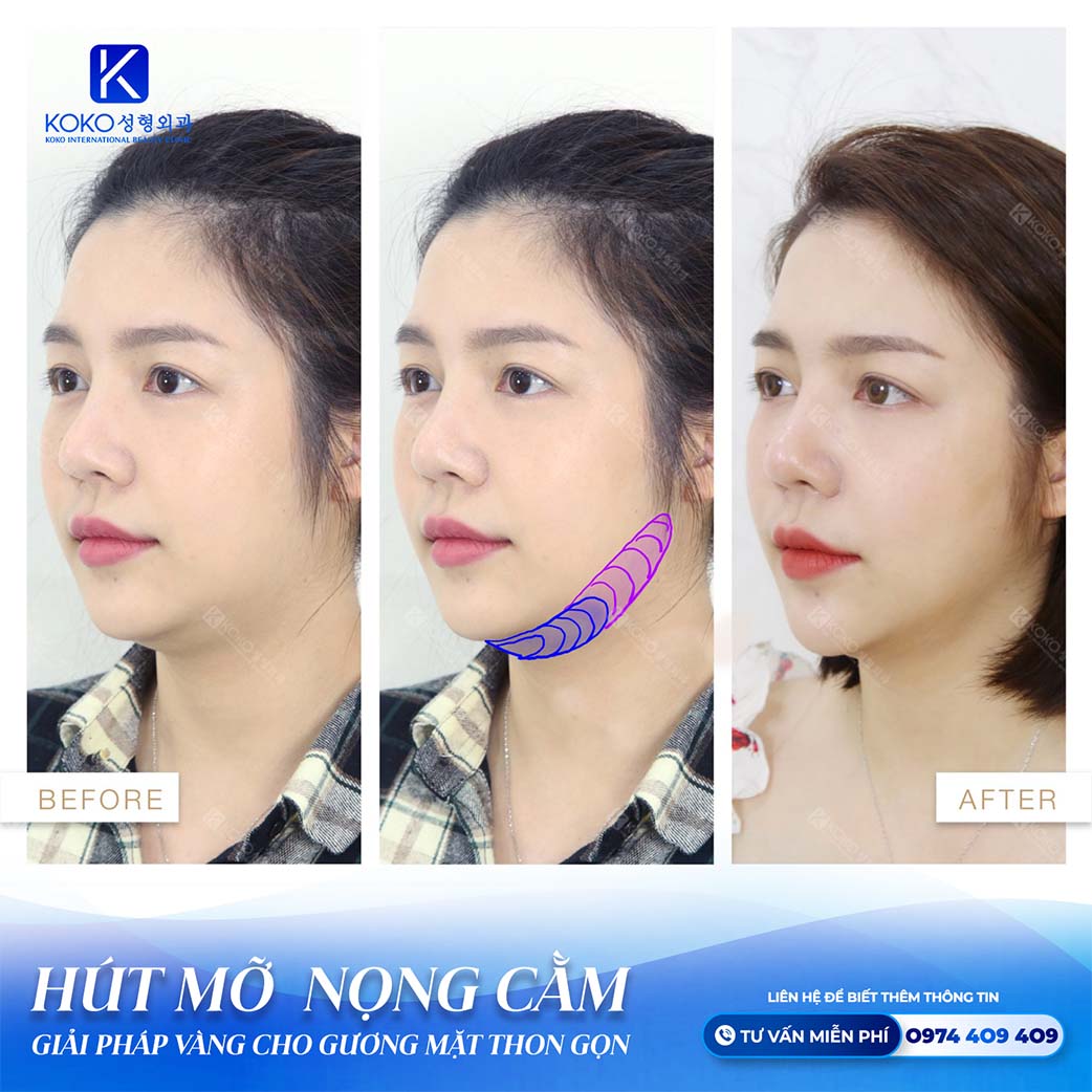 Hút mỡ nọng cằm bao lâu lành thẩm mỹ koko