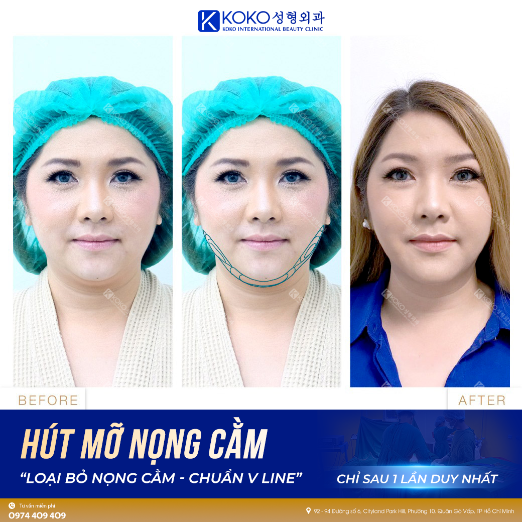 Hút mỡ nọng cằm không phẫu thuật Lipo Nano 5.0