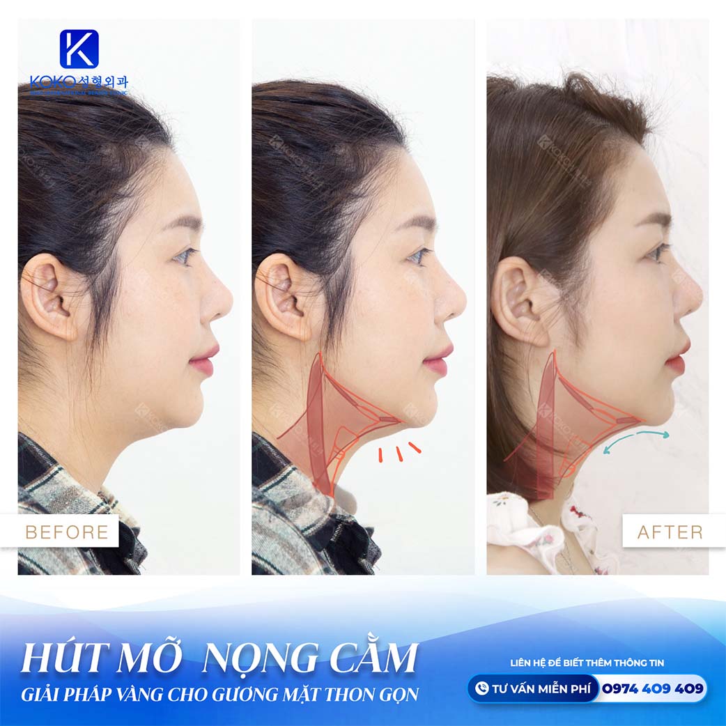 thẩm mỹ koko hút mỡ nọng cằm