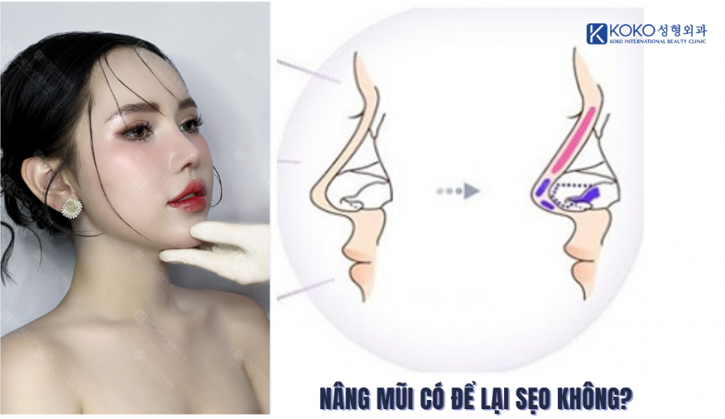 Nâng Mũi Có Để Lại Sẹo Không?