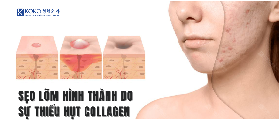 Sẹo lõm hình thành do sự thiếu hụt collagen