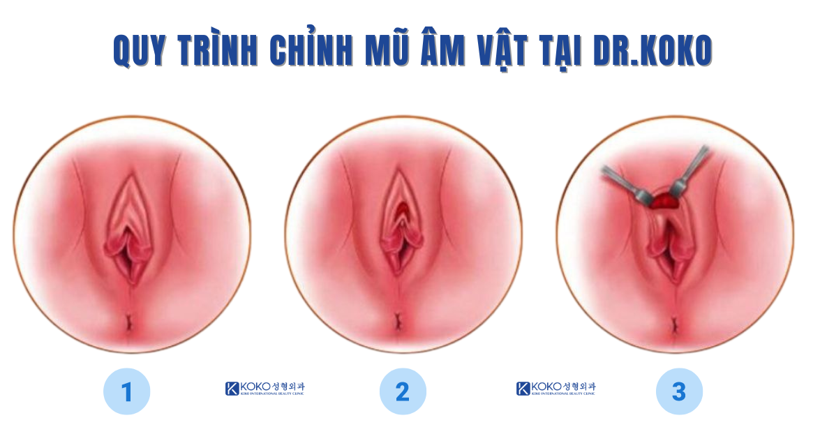 Quy trình chỉnh mũ âm vạt tại Dr.KOKO