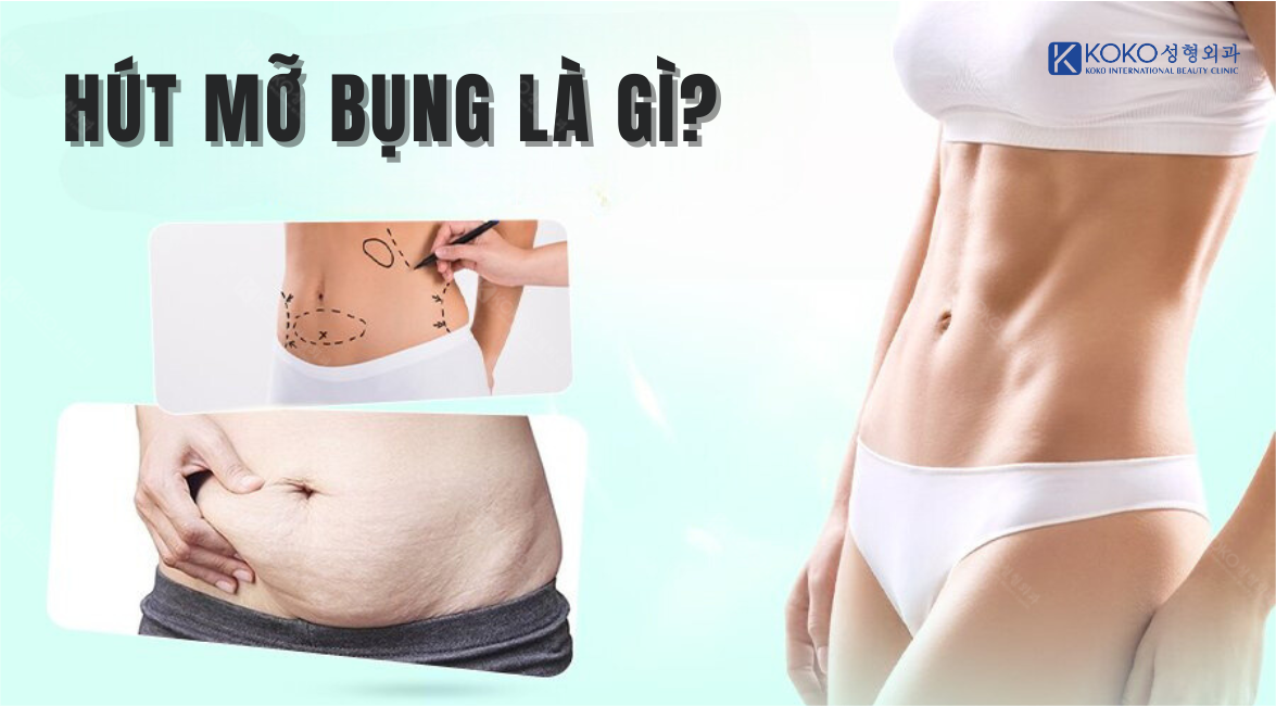 Hút Mỡ Bụng Là Gì?