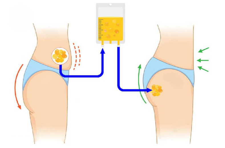 Quy Trình Cấy Mỡ Mông Bằng Mỡ Tự Thân