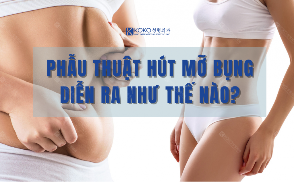 Phẫu Thuật Hút Mỡ Bụng Diễn Ra Như Thế Nào?