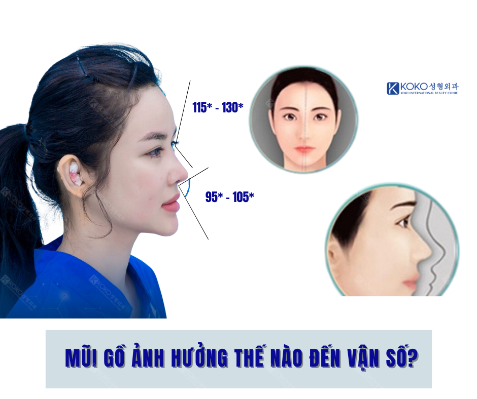 Mũi Gồ Ảnh Hưởng Thế Nào Đến Vận Số? KOKO