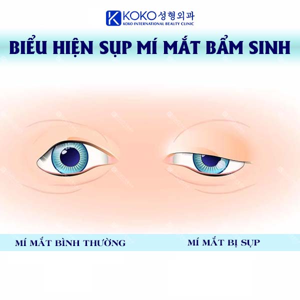 Biểu Hiện Của Sụp Mí Mắt Bẩm Sinh KOKO