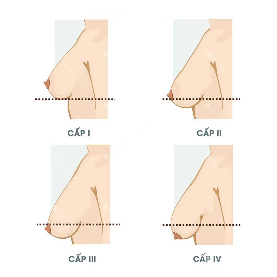 Các Cấp Độ Sa Trễ Của Ngực