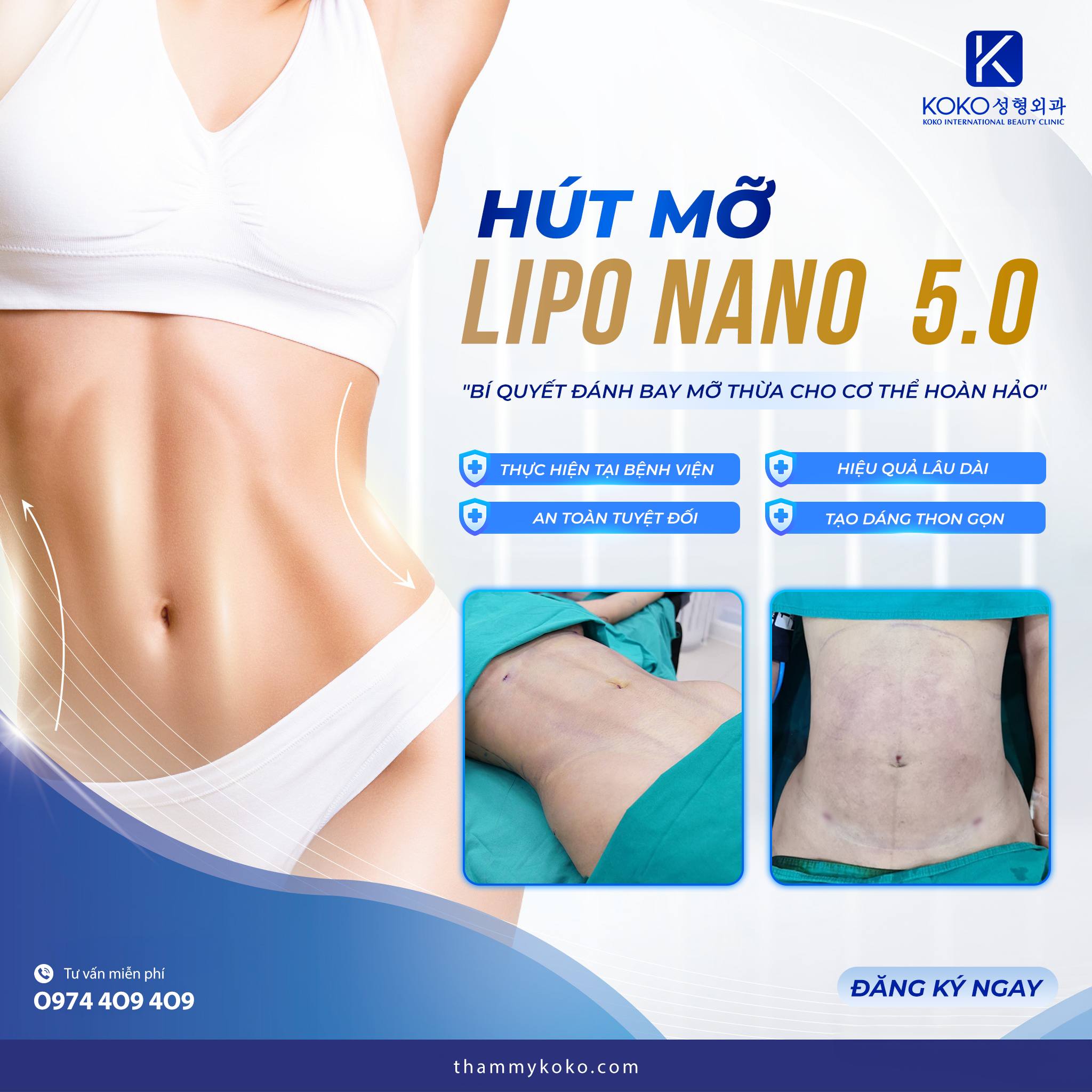 Hút mỡ Lipo Nano 5.0 giúp đào thải mỡ thừa hiệu quả