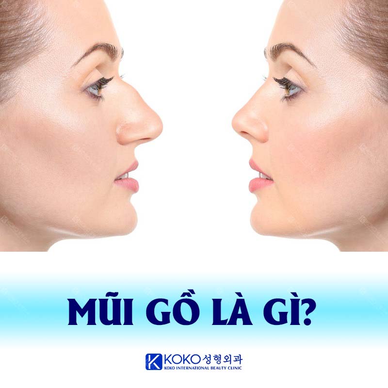 Mũi Gồ Là Gì? - koko