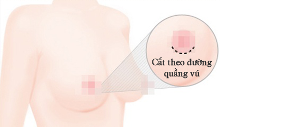 Nâng Ngực Qua Đường Quầng Vú