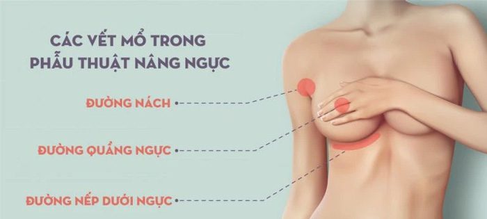 Ba đường nâng ngực phổ biến được các bác sĩ chuyên môn thẩm mỹ lựa chọn để thực hiện phẫu thuật vùng ngực