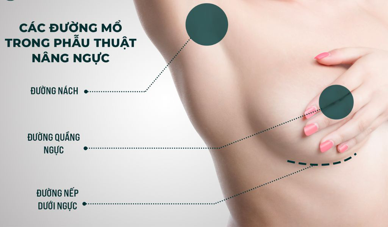 Phẫu thuật nâng ngực là gì?