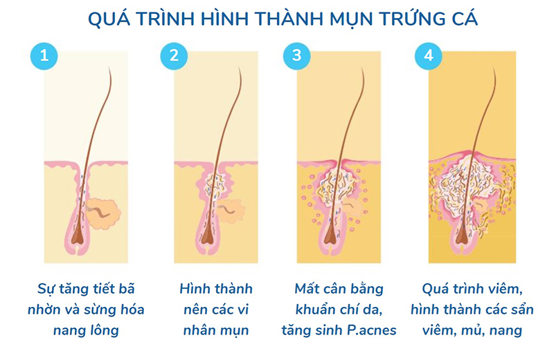 Quá trình hình thành mụn trứng cá.