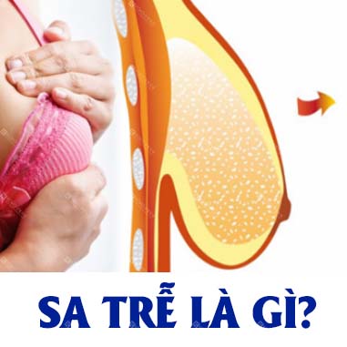 Sa Trễ Là Gì? KOKO