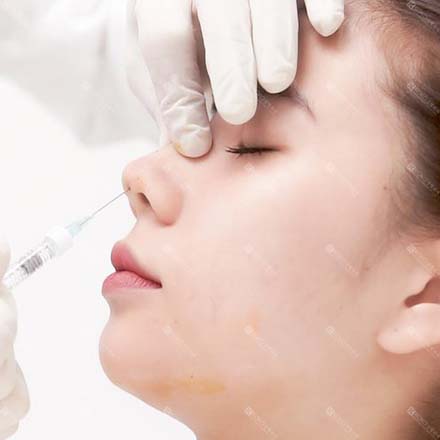 Tiêm Filler Mũi Sửa Mũi Gồ koko