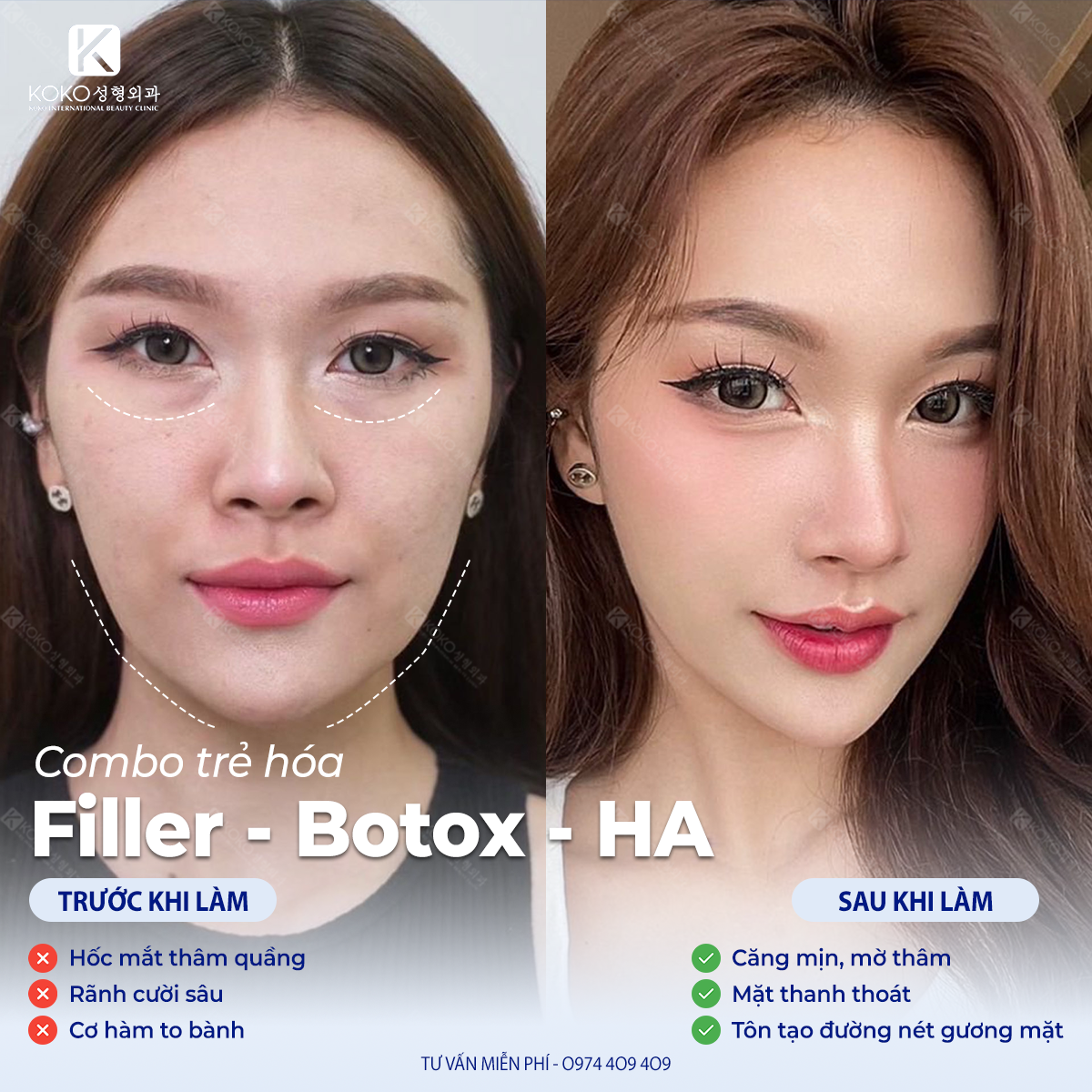 Combo Filler & Botox trẻ hóa