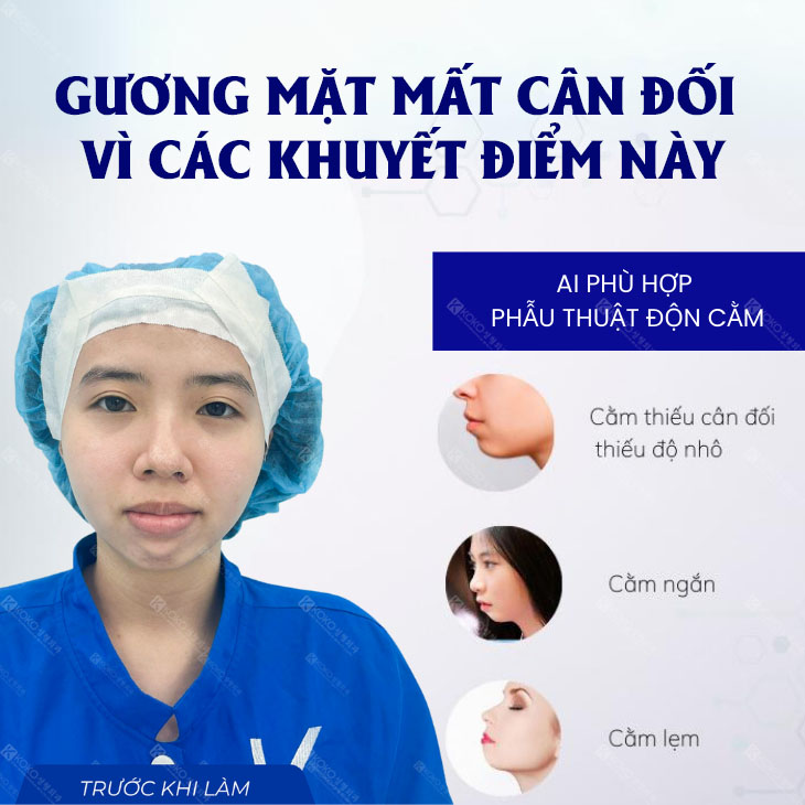 Ai thích hợp độn cằm?