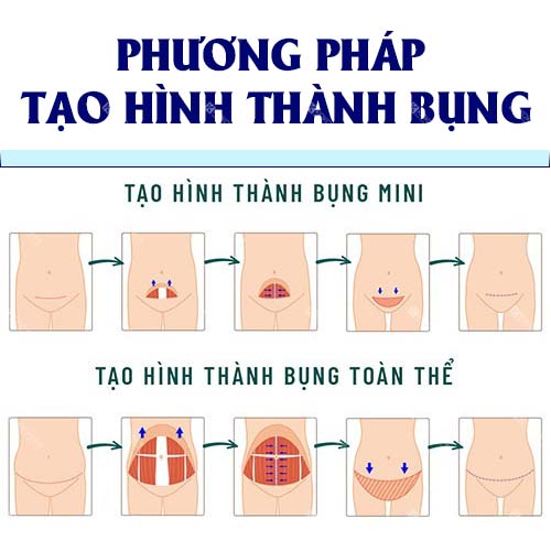 Các phương pháp tạo hình thành bụng