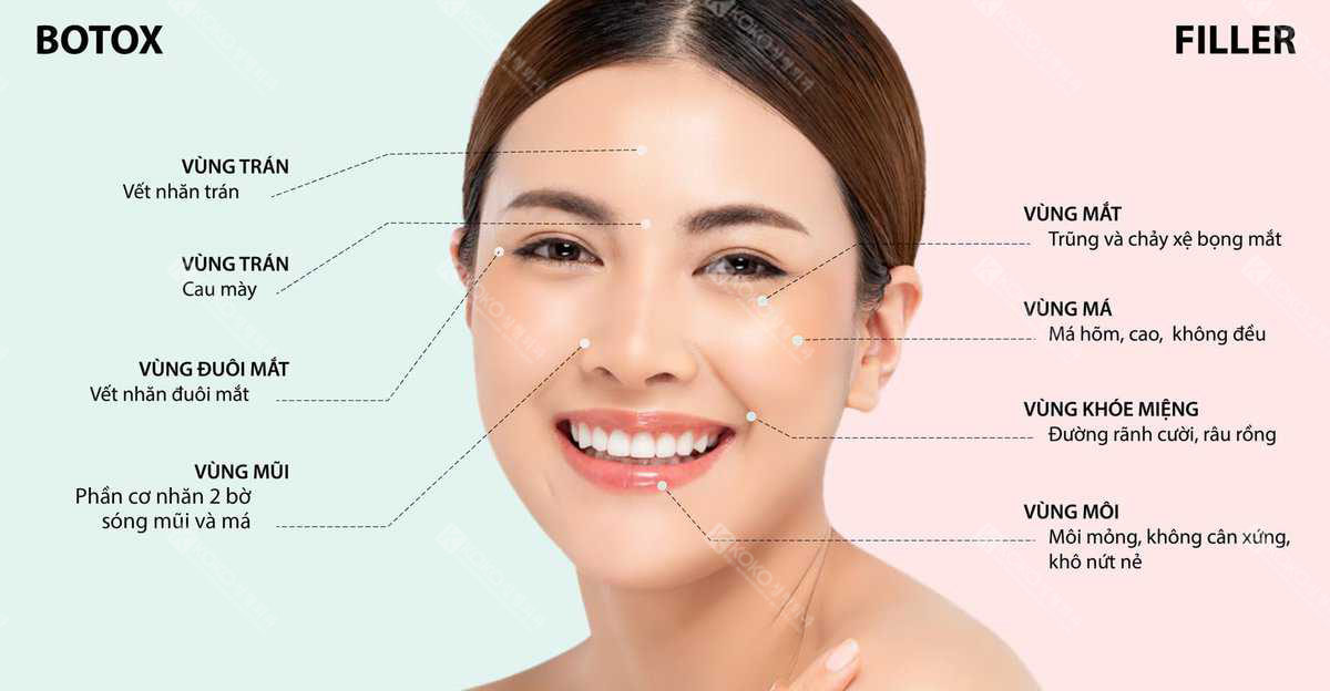 Các vị trí cần tiêm Filler & Botox