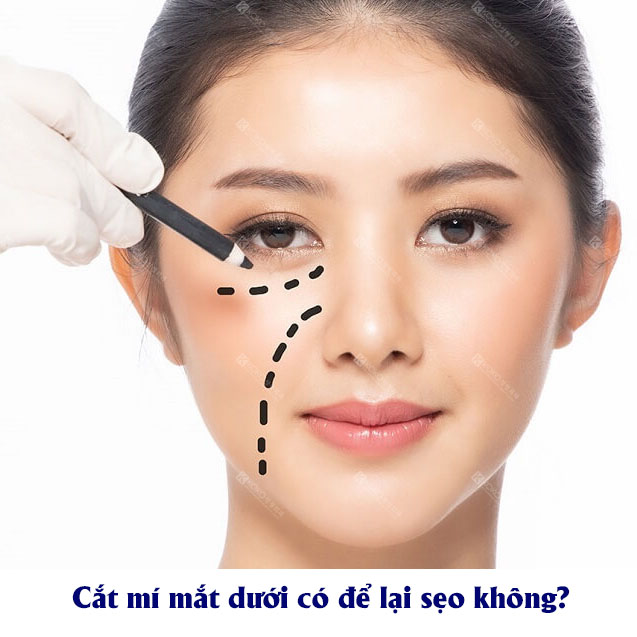 Cắt Mí Dưới Có Để Lại Sẹo Không?