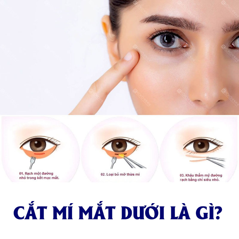 Cắt Mí Dưới Là Gì?