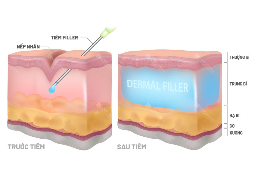 Cơ chế hoạt động của Filler