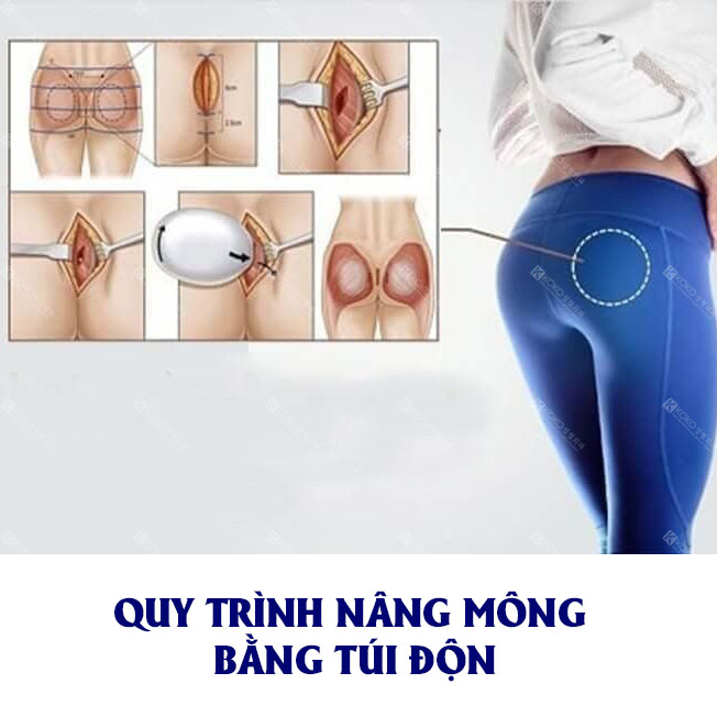 Nâng Mông Bằng Túi Độn Quy Trình Diễn Ra Như Thế Nào?