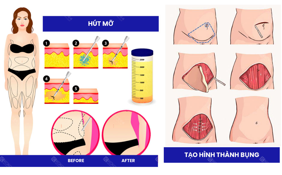 Tạo Hình Thành Bụng Có Đau Không?