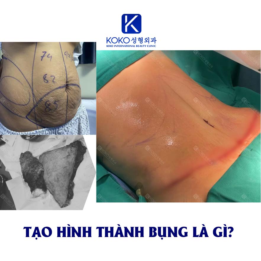 Tạo hình thành bụng là gì?