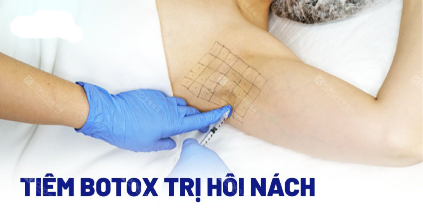 Tiêm Botox là một trong những phương pháp điều trị hôi nách hiệu quả