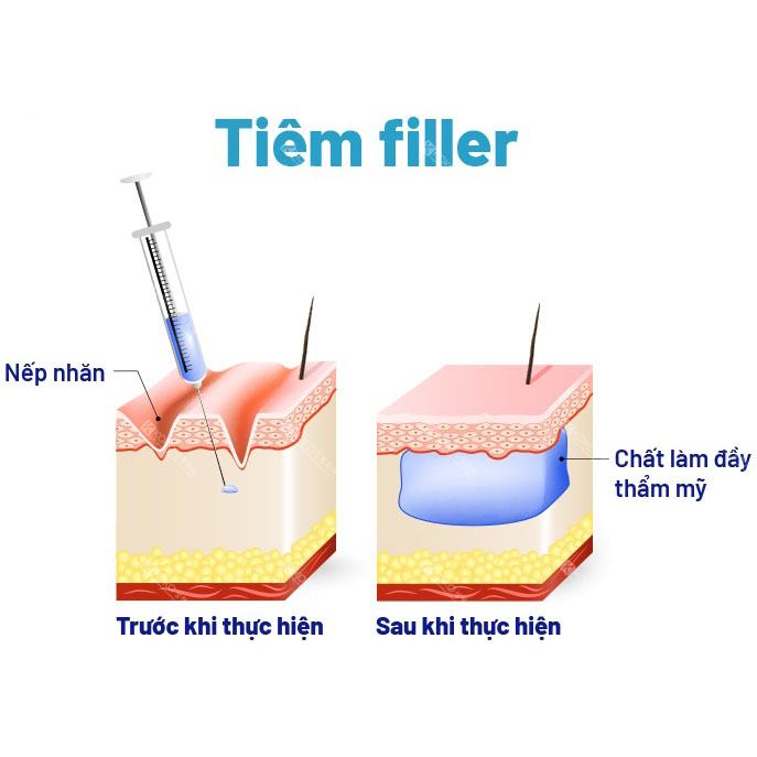 Tiêm Filler là gì?