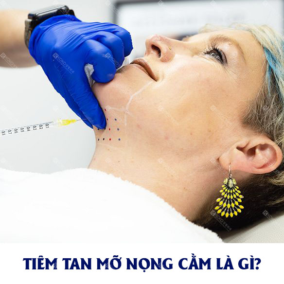 Tiêm tan mỡ nọng cằm là gì?