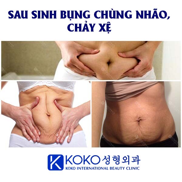 Cách trường hợp nên thực hiện tạo hình thành bụng